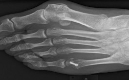 Wissenschaft: Hallux valgus und Langlauf, geht das?